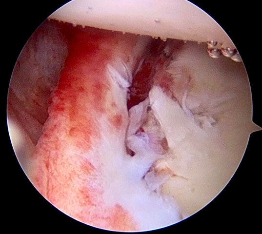 Inestabilidad de Hombro 1 Inestabilidad de Hombro. Lesión de Bankart. Dr. Pablo Carnero. Imatde Arthrosport