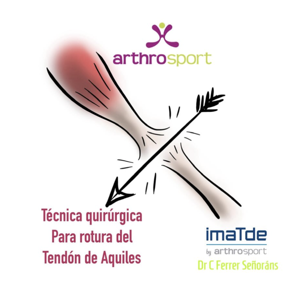 Reparación de rotura del tendón de aquiles, dr carlos ferrer señoráns, imatde arthrosport, medicina regenerativa, cirugía de tendones en málaga
