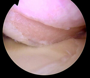 Inestabilidad de Hombro. Dr Pablo Carnero. Imatde Arthrosport