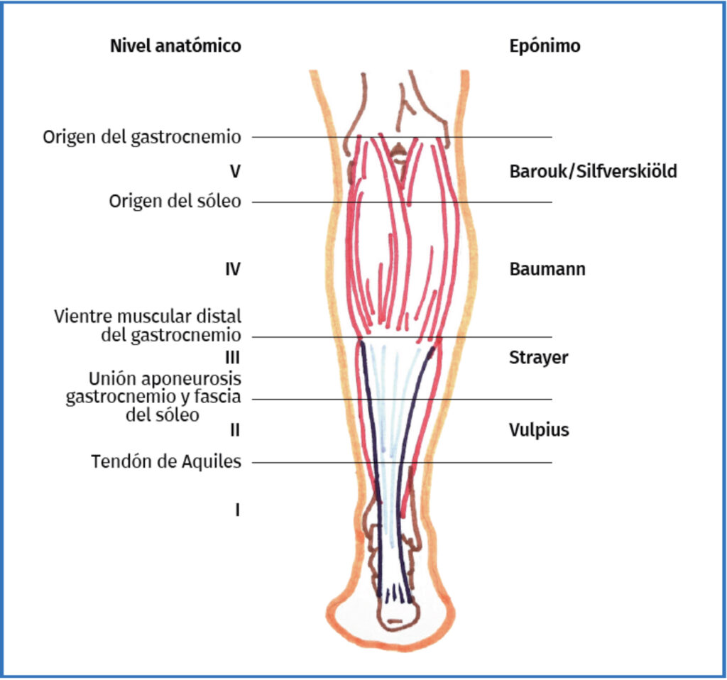 Alargamiento bilateral de gemelos con técnica de Barouk – Drs. Ferrer y Álvarez 1 Mapa de los distintos abordajes quirúrgicos clásicos en alargamiento de gemelos