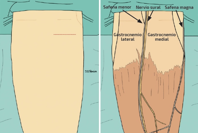 Alargamiento bilateral de gemelos con técnica de Barouk – Drs. Ferrer y Álvarez 2 Mapeo topográfico de estructuras neurovasculares mediante control ecográfico