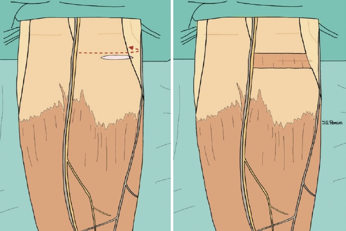 Alargamiento bilateral de gemelos con técnica de Barouk – Drs. Ferrer y Álvarez 3 Esquema del abordaje quirúrgico y del efecto de la aponeurectomía en la fascia del gemelo medial