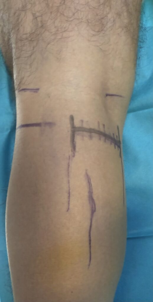 Alargamiento bilateral de gemelos con técnica de Barouk – Drs. Ferrer y Álvarez 4 Mapeo topográfico de estructuras neurovasculares mediante control ecográfico