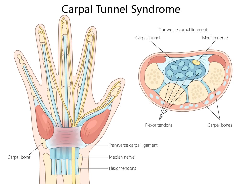 Síndrome del Túnel Carpiano 1 Ilustración didáctica síndrome del túnel carpiano