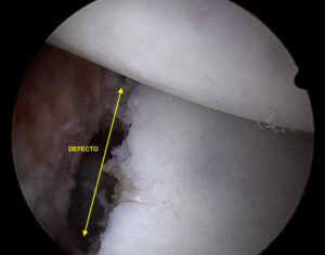 Imagen artroscópica de un defecto óseo en el hombro